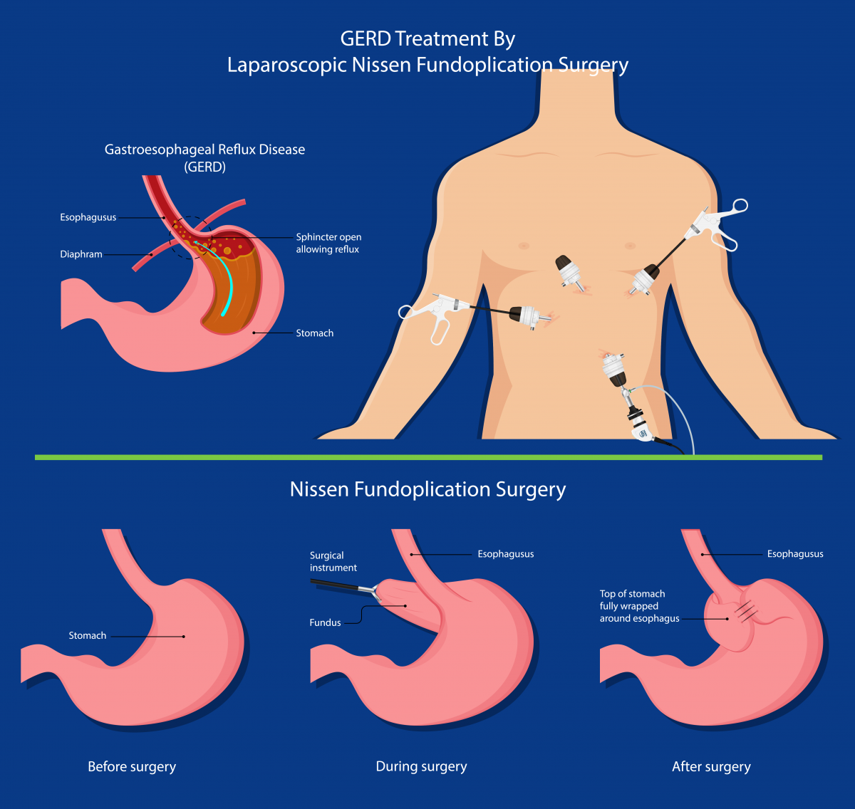 Anti Reflux Surgery Southern Surgical Care