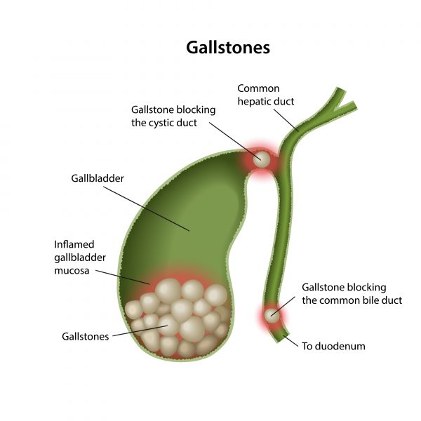 Gallstones – Southern Surgical Care